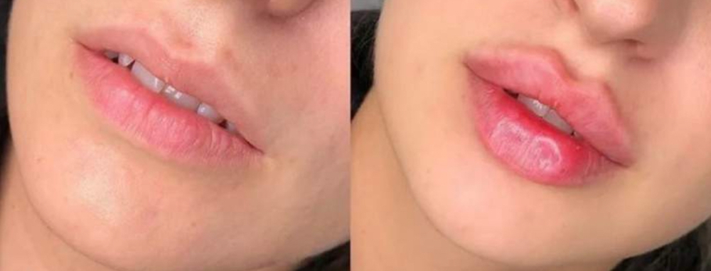 Juvederm 1ML Lip Filler
