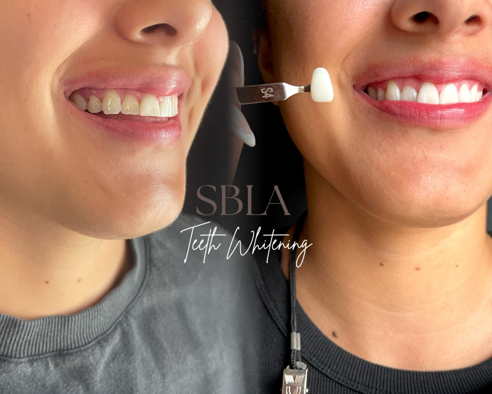 Professional Teeth Whitening-Studio