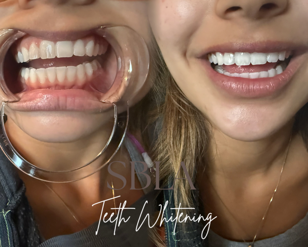 Professional Teeth Whitening-Studio