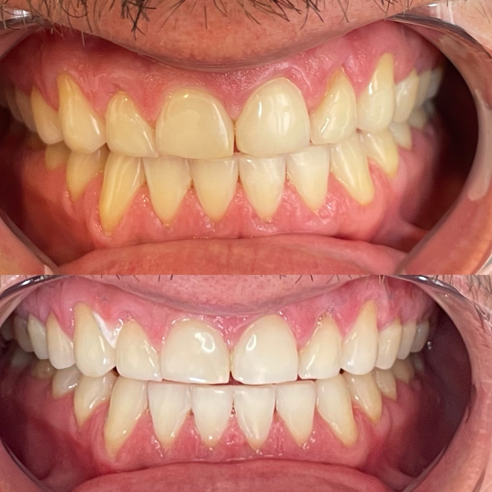 9/30 Flash Sale OneHour Whitening
