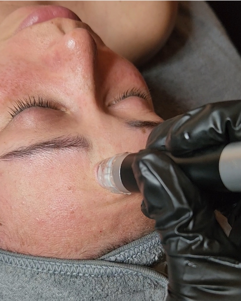 Hydrodermabrasion Facial/8 Sessions