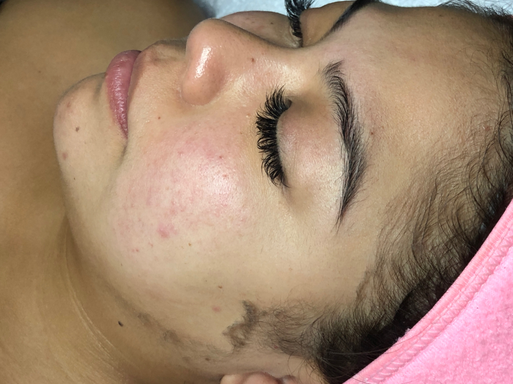 Add On Dermaplaning