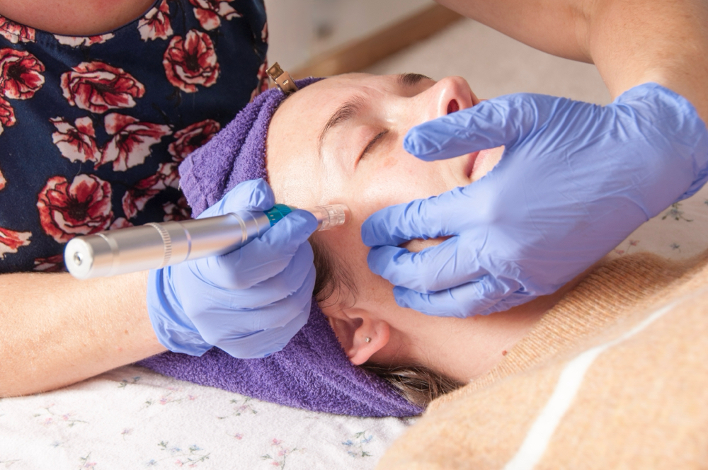 Microneedling Session at Acupuncture North in Minneapolis, MN