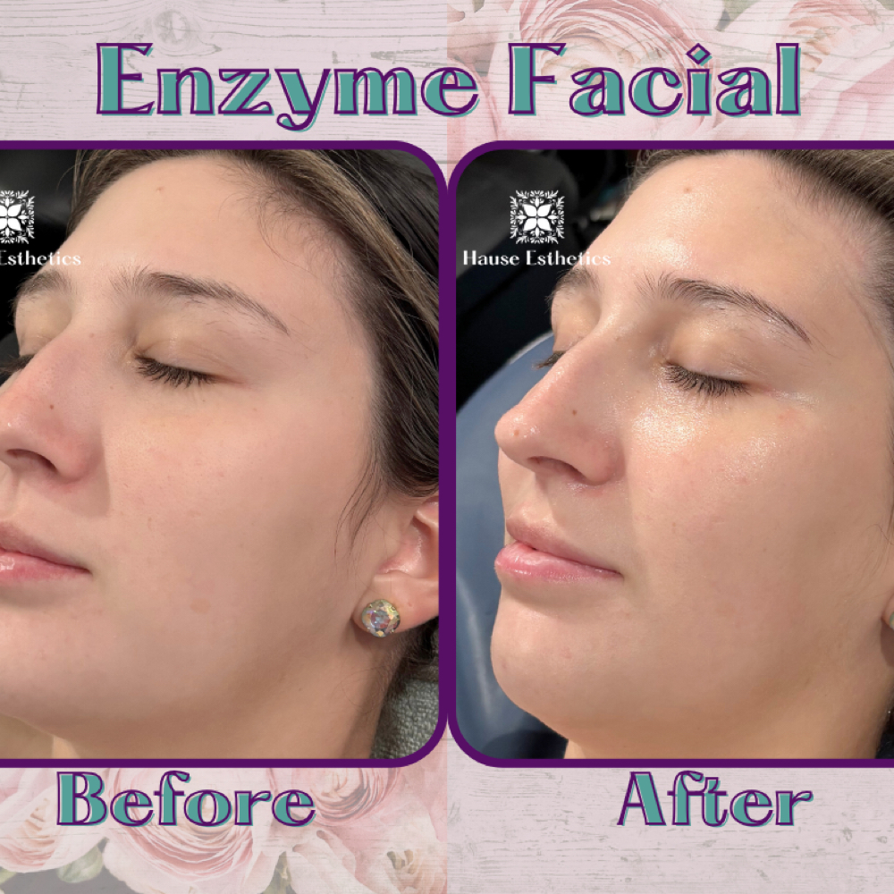 The Enzyme Facial at Hause Esthetics in Morristown, TN
