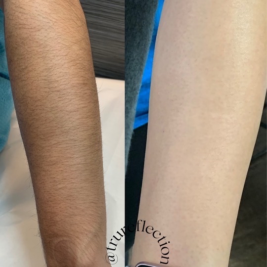 Full Arm