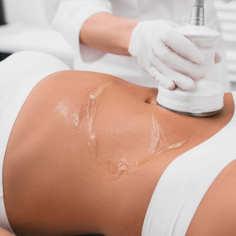 Ultrasound Cavitation