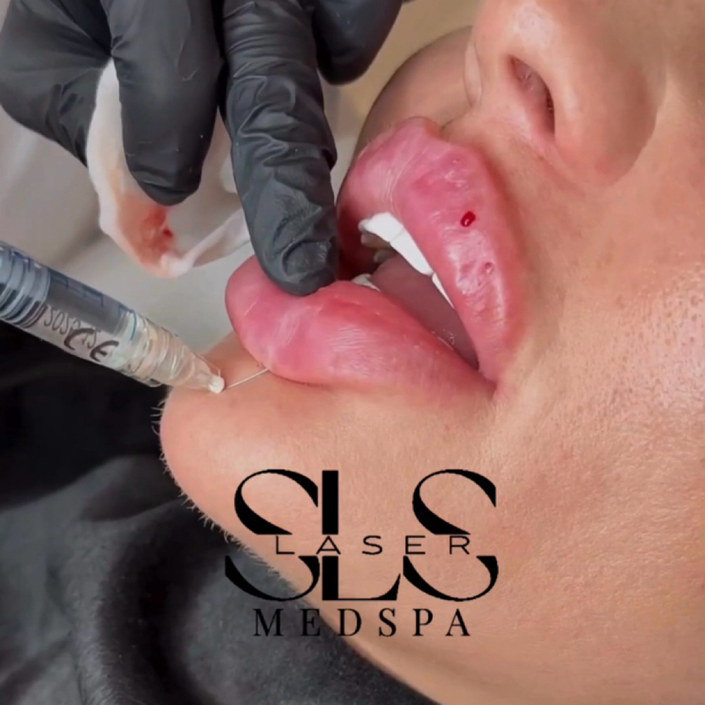 1 Syringe of Vobella/ Consultation at SLS Laser Medspa in Ontario, CA