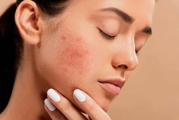 Acne Clarifying Peel