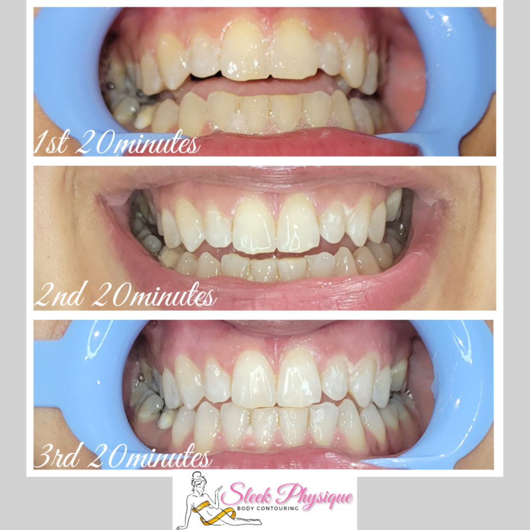 Pearly Whites at Sleek Physique in Elgin, TX