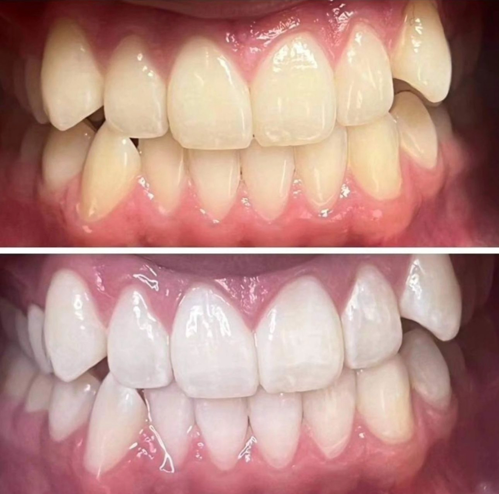 Teeth Whitening