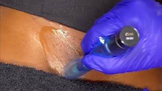 Pubic Mound + Labia Brightening