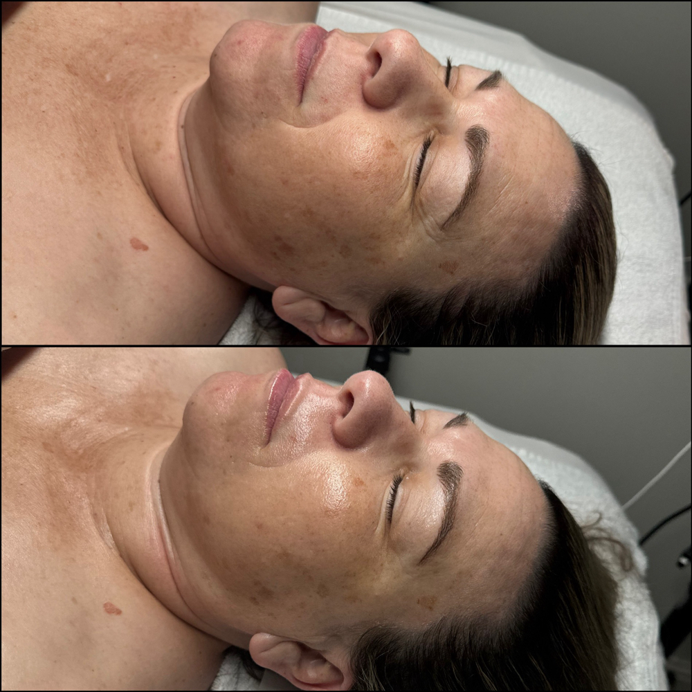 Anti Aging Facial