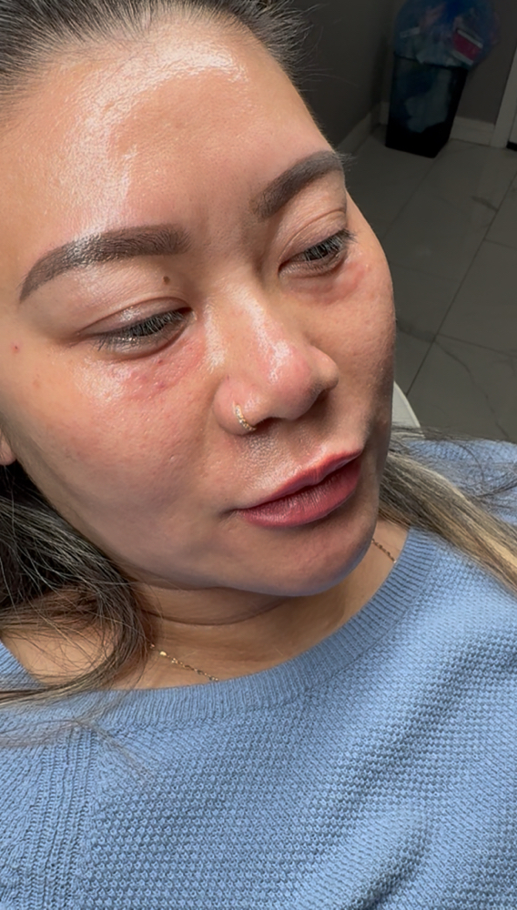 Under Eye Biostimulator at Balance.Bar.Aesthetics in Berkeley, CA