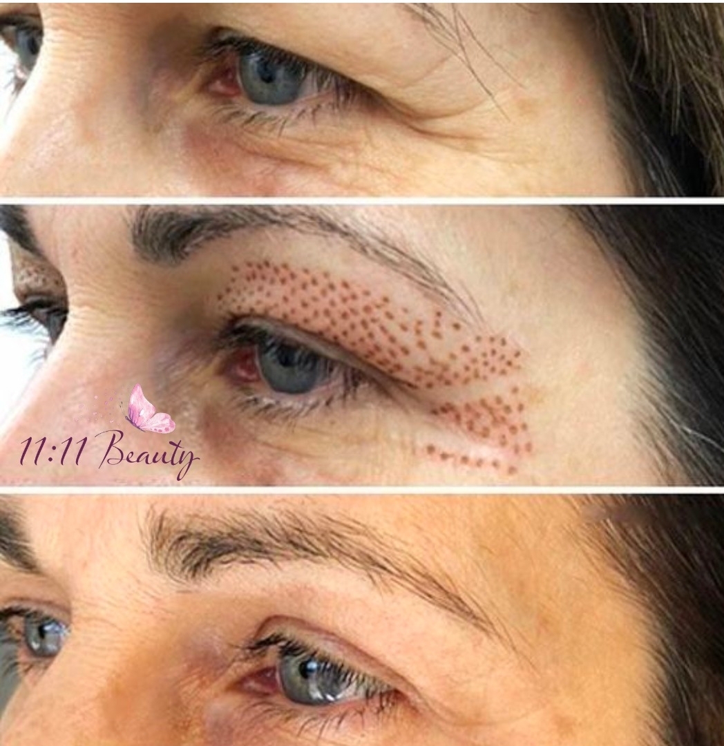 Upper eyelids