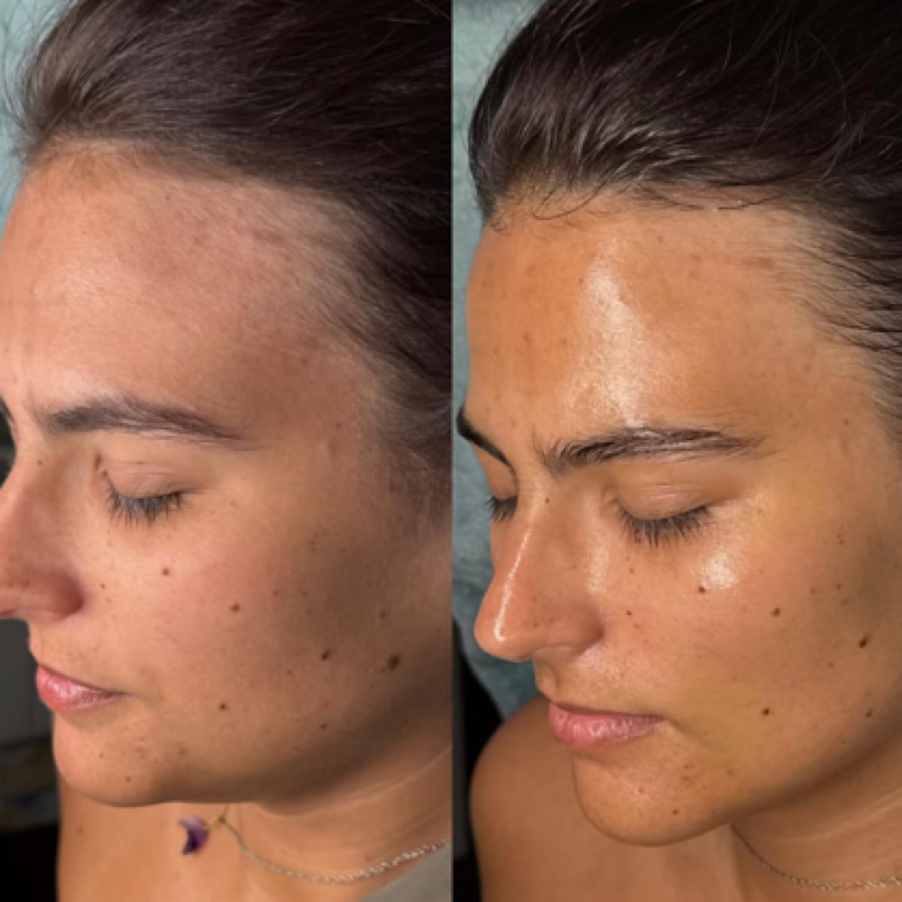 Dermaplane at Radiance Beauty in Kingsport, TN