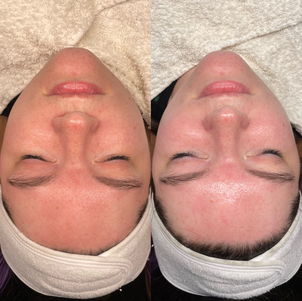 Dermaplane