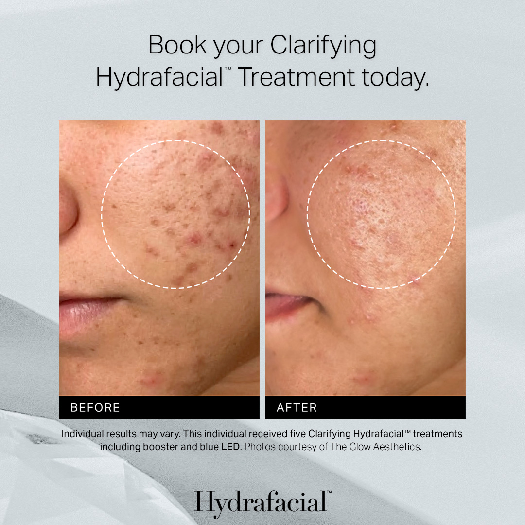 HydraFacial Teen Acne