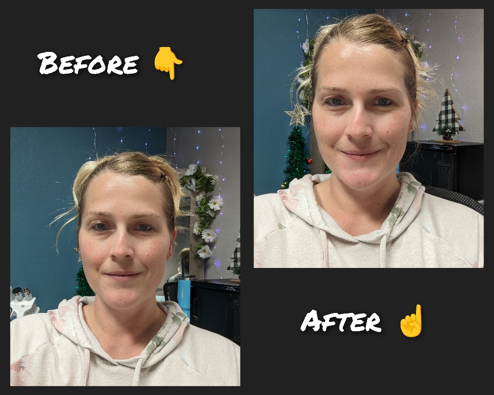 Hydrafacial