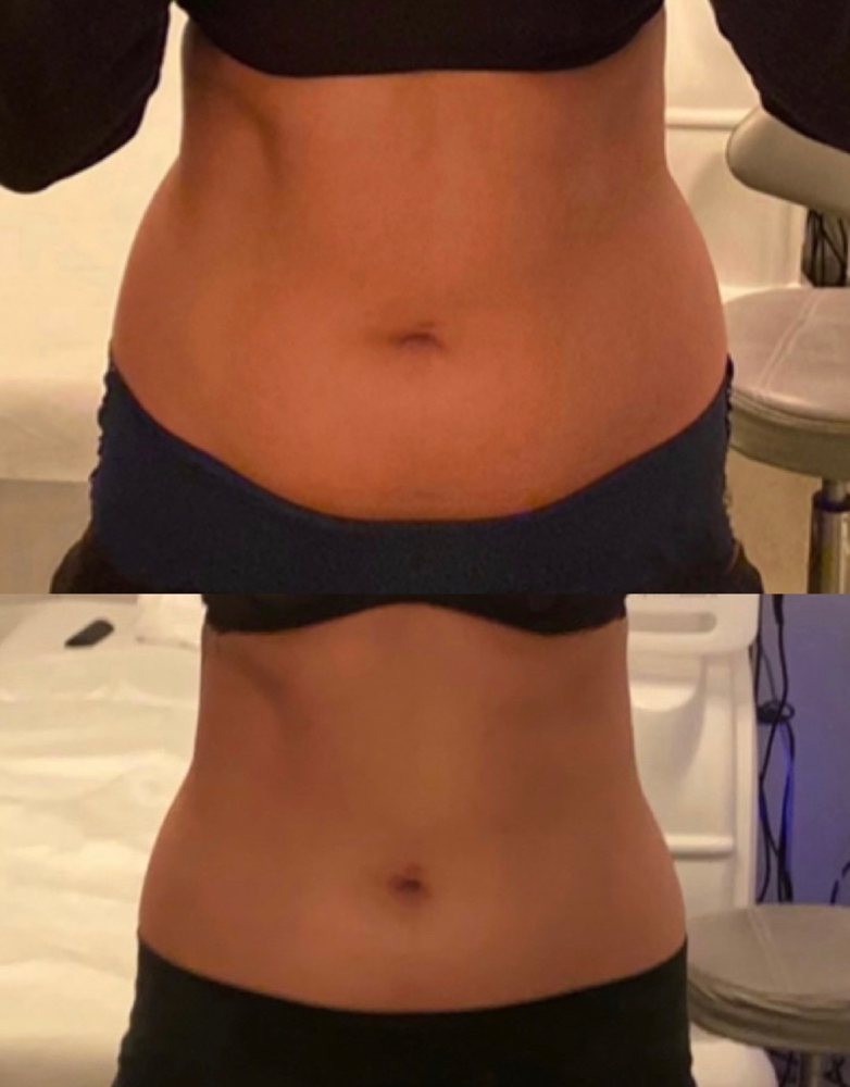 Body Contouring/fat buring
