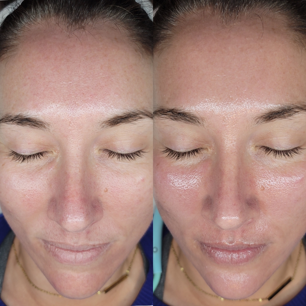 The Chill & Glow Facial