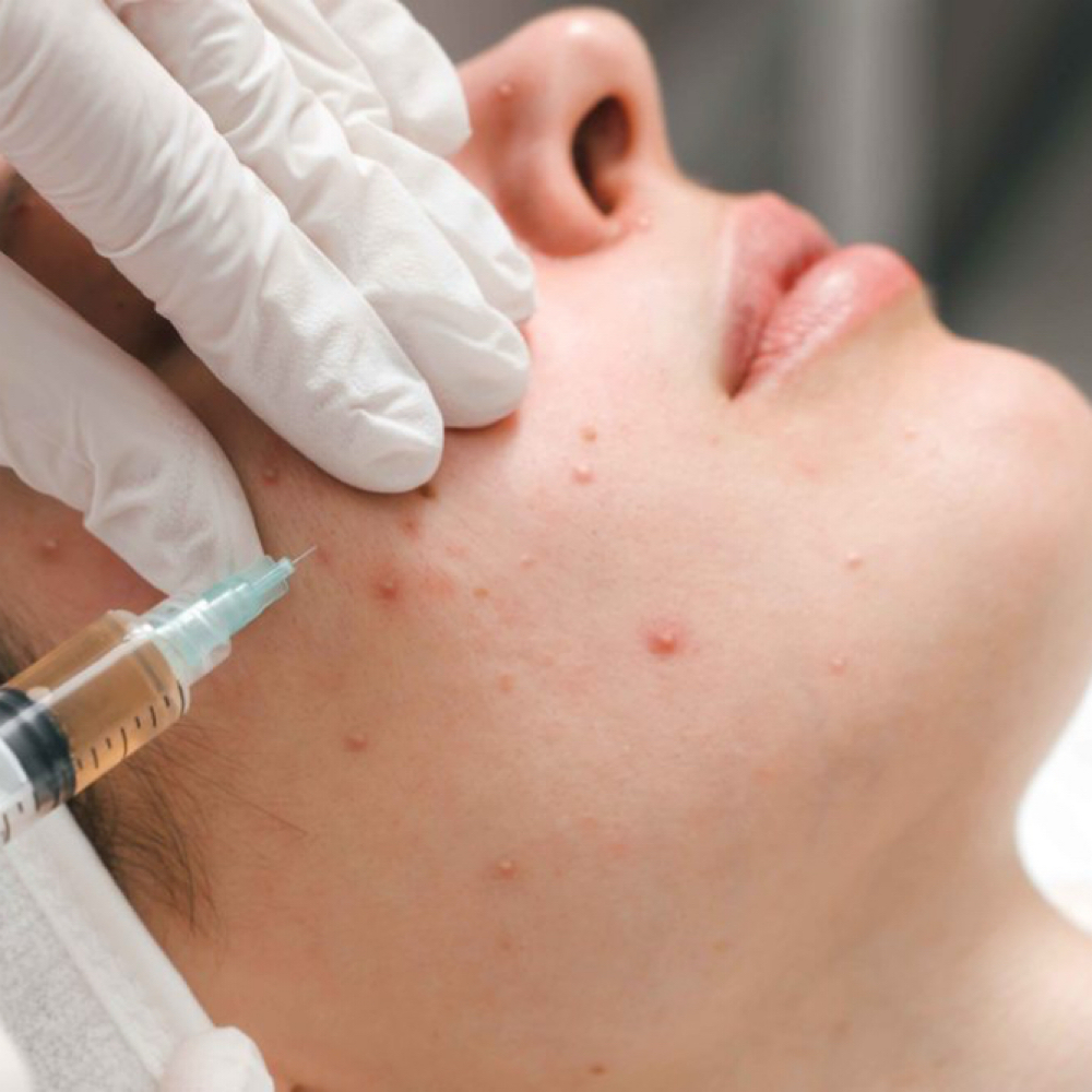 Acne/keloid Injections at Aesthetik Nurse Kat in Riverside, CA
