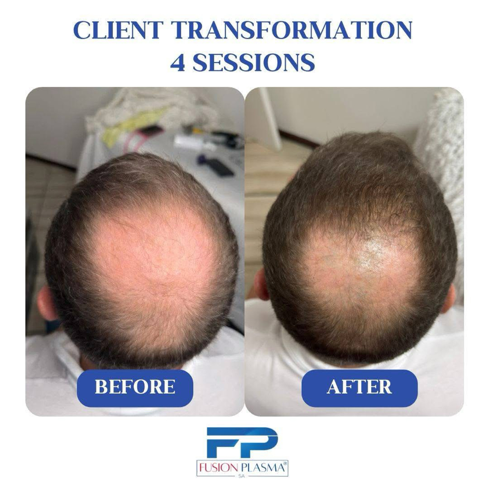 Hair Restoration Fusion Plasma