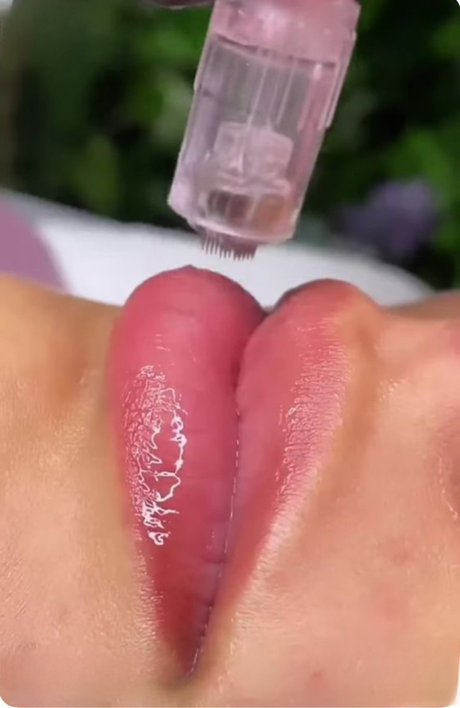 MICRONEEDLING FOR LIP HYDRATION