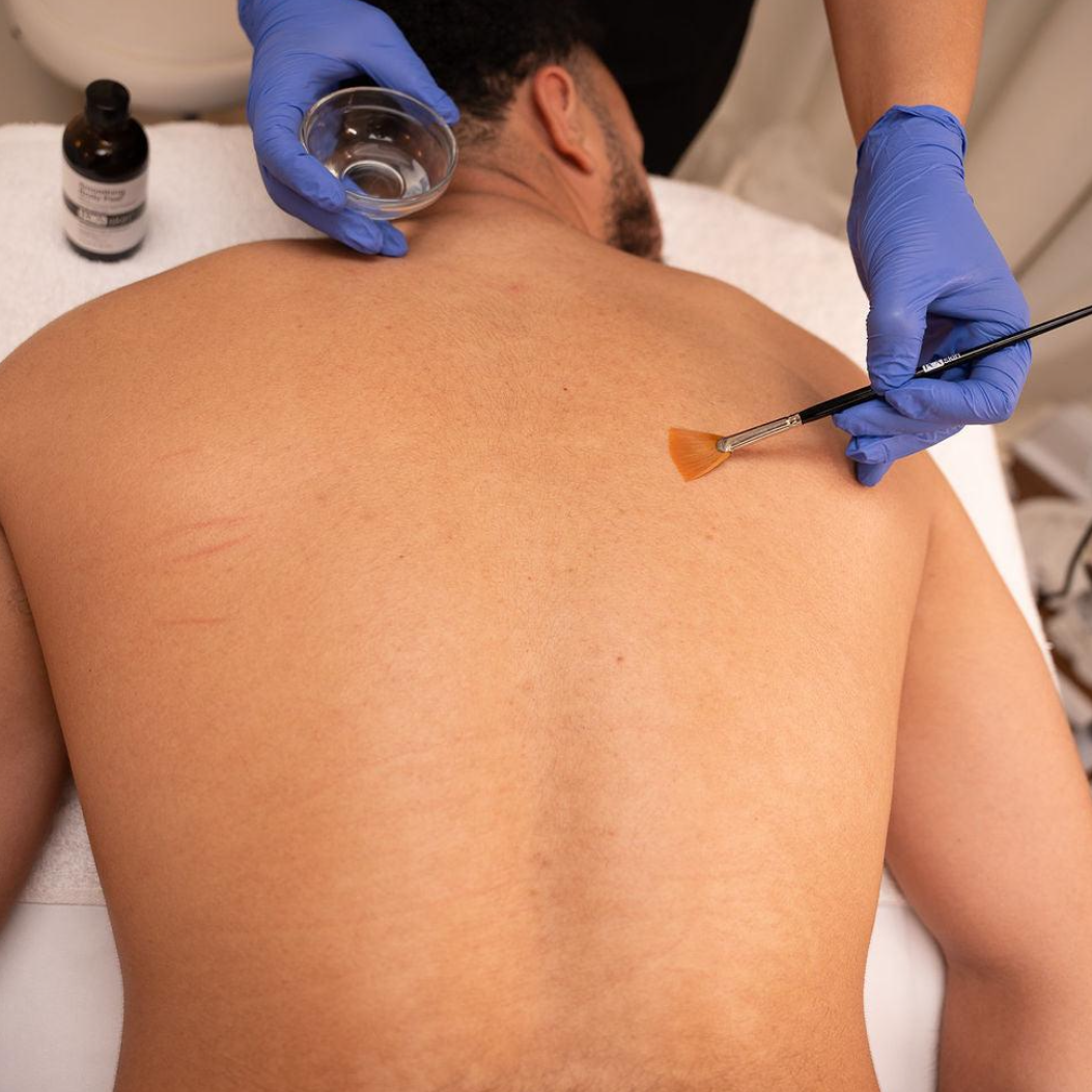 Back Clearing Treatment at Aesthetics by Aunnie in Costa Mesa, CA