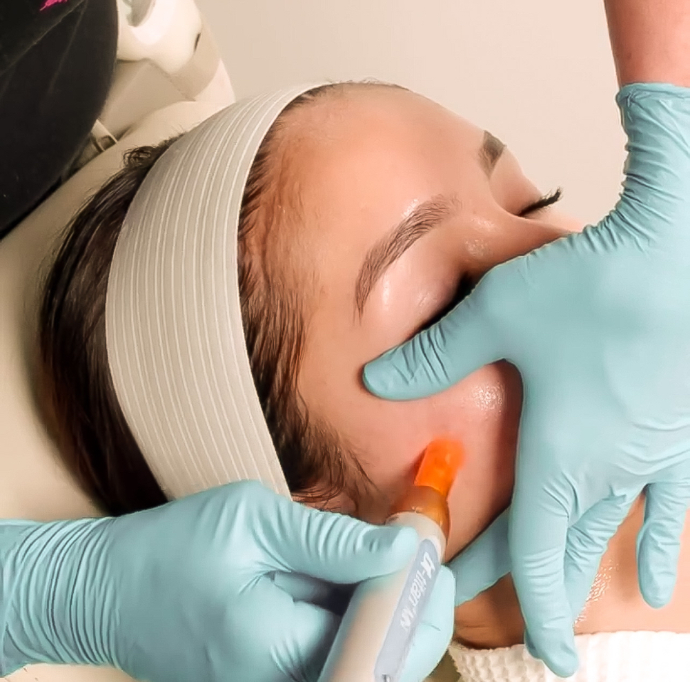 MN Microexfoliation Facial