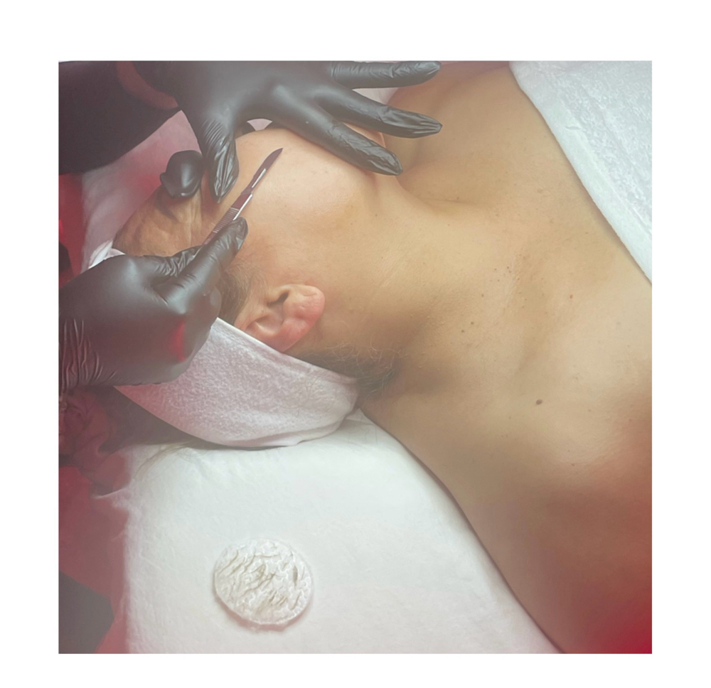Dermaplaning