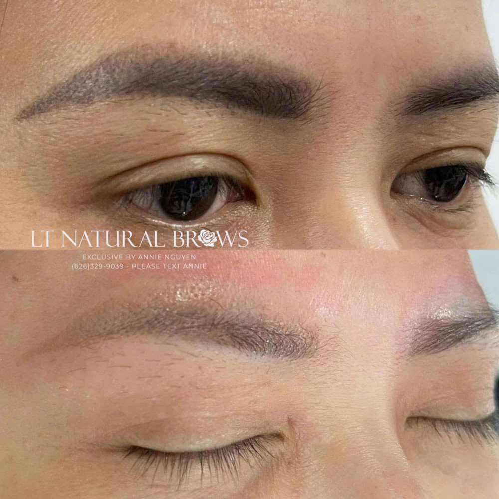 TATTOO REMOVAL EYEBROWS