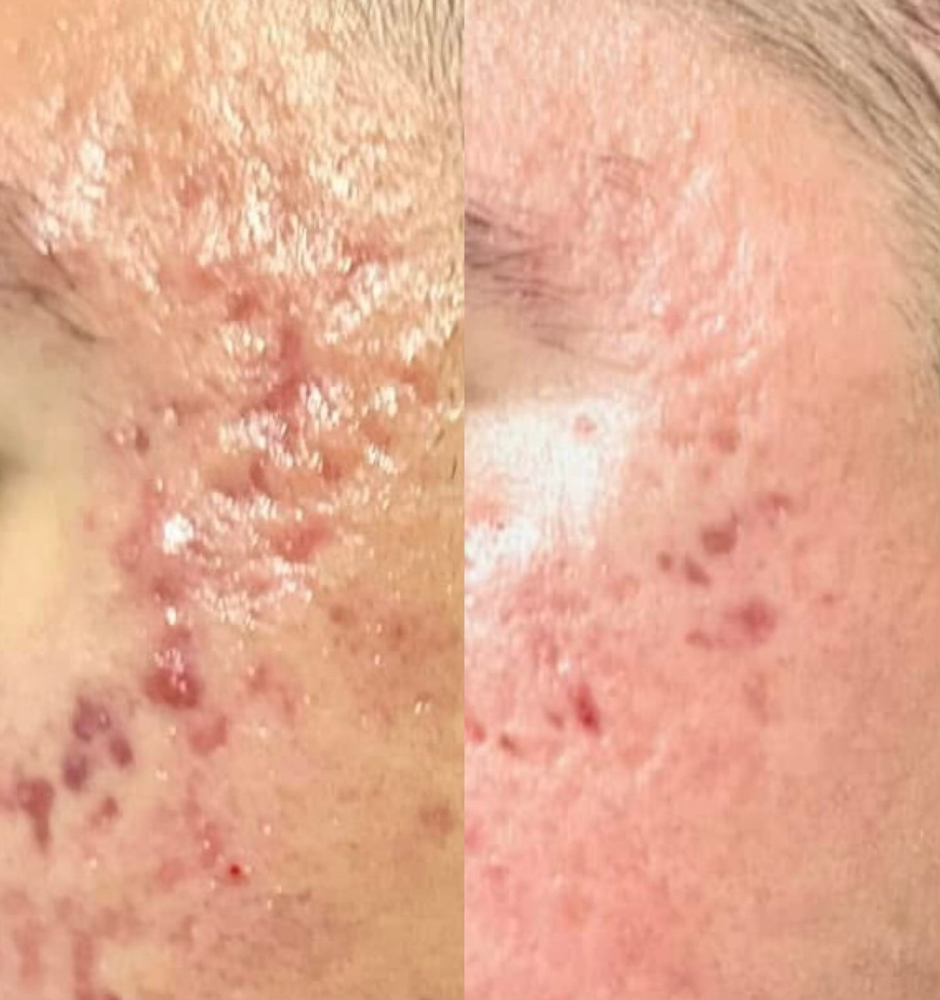 ACNE SCAR REPAIR