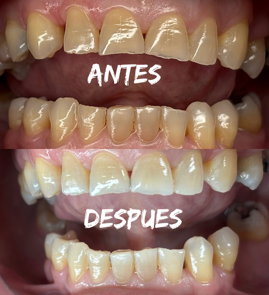 Teeth Whitening at GLAMS BY LOURIAM in Harrisonburg, VA