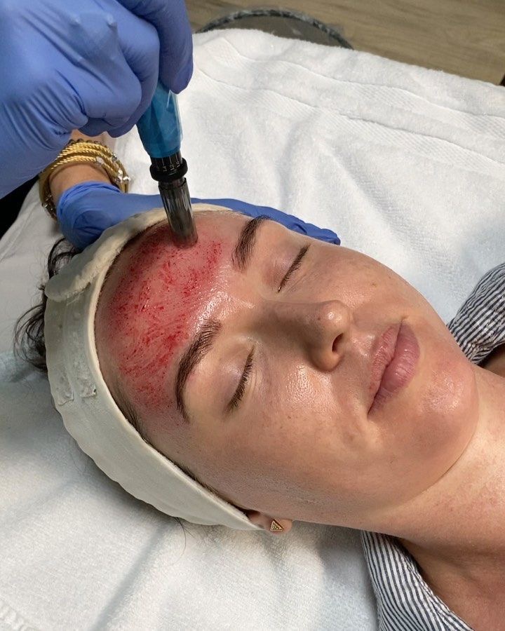 Collagen Renewal Treatment