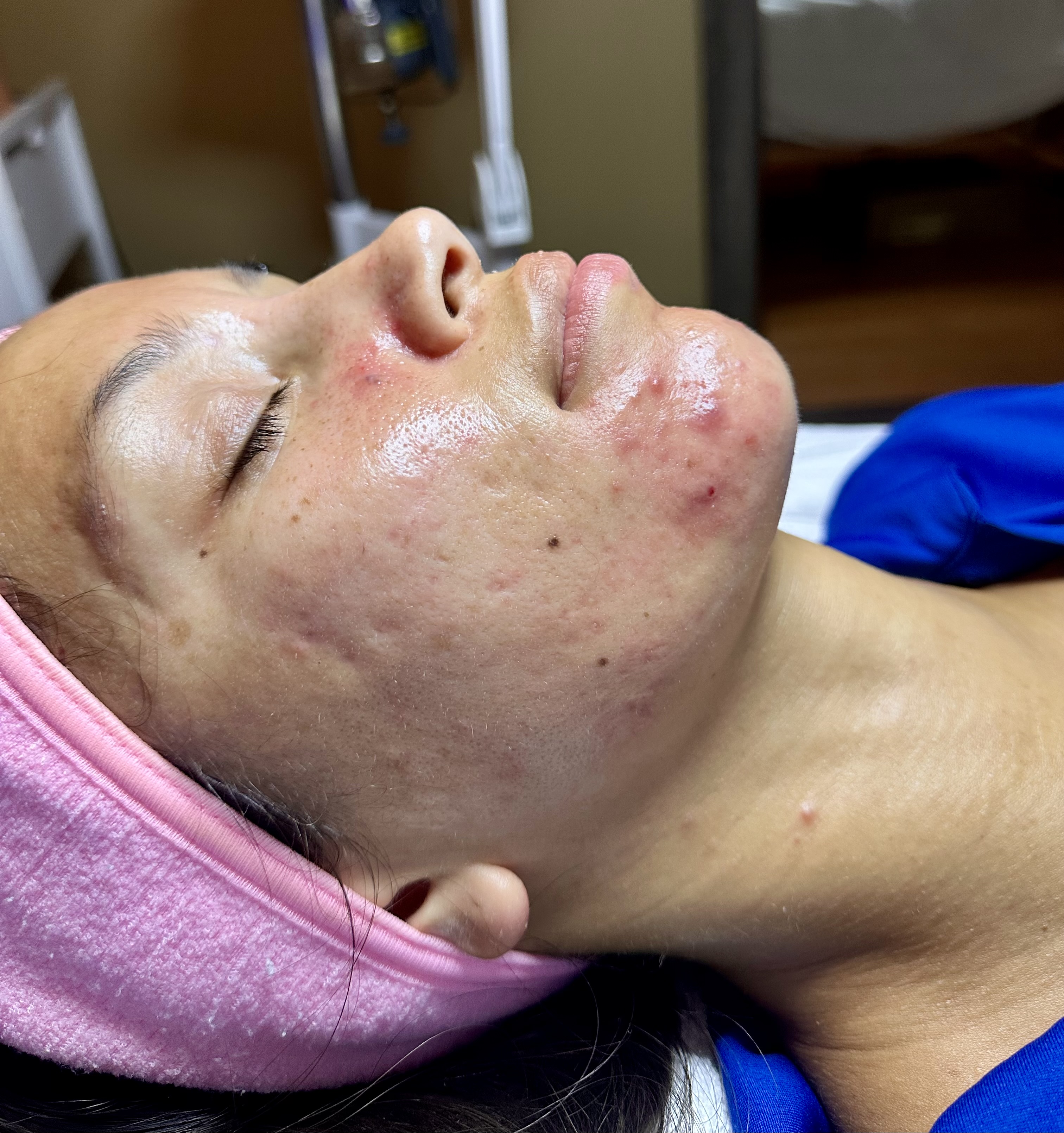Advanced Acne Clearing Treatment