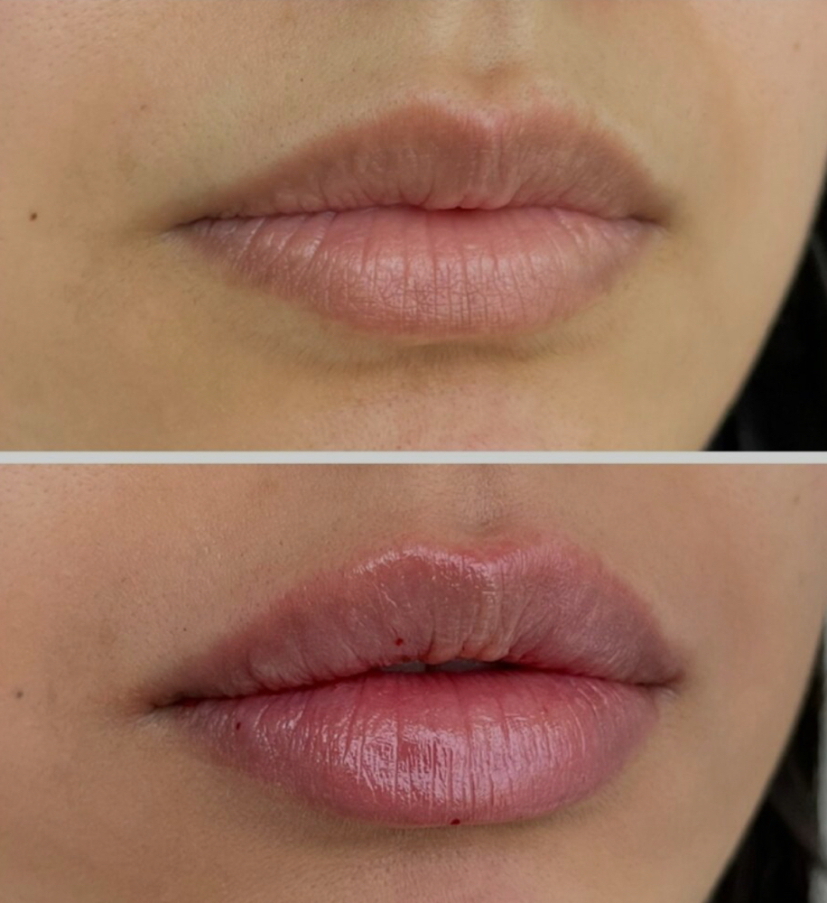 Restylane Kysse 1 ml