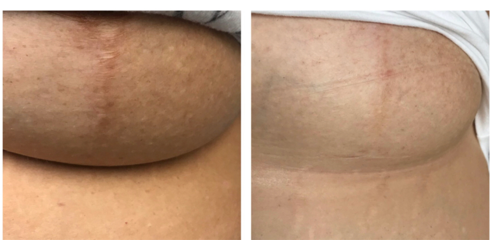 Surgical Breast Scar 3 Treatments