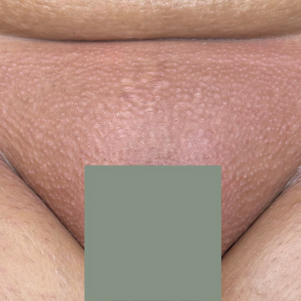 Brazilian Wax at Crystal Clear Skin by Madison in Sherman, TX