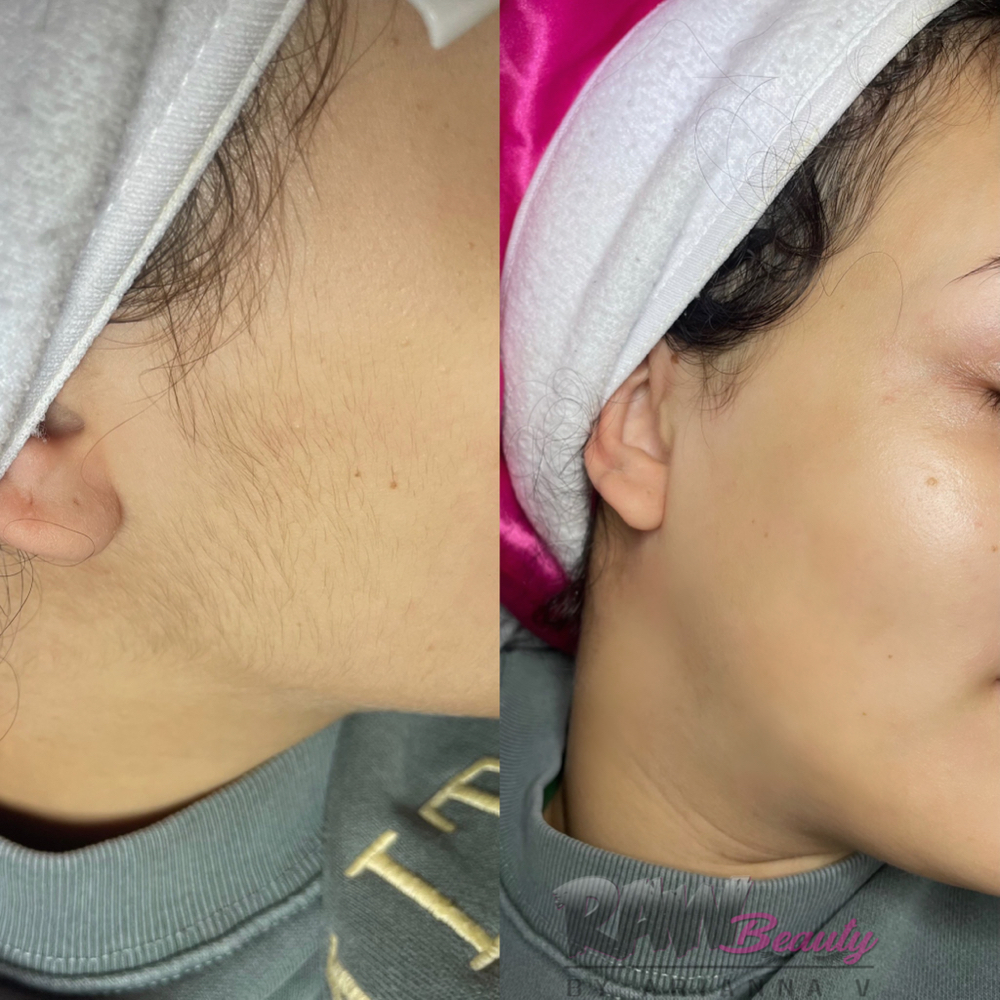 Dermaplaning