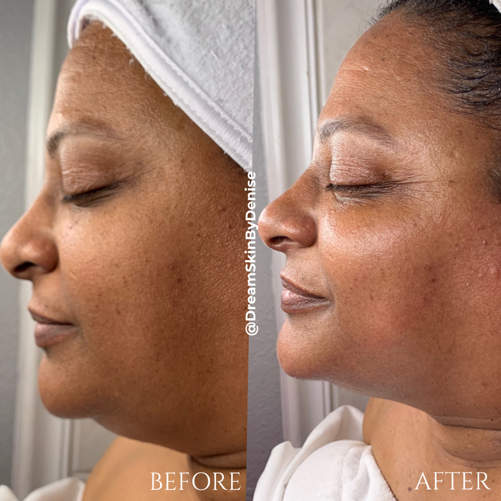 Skin Tightening Facial