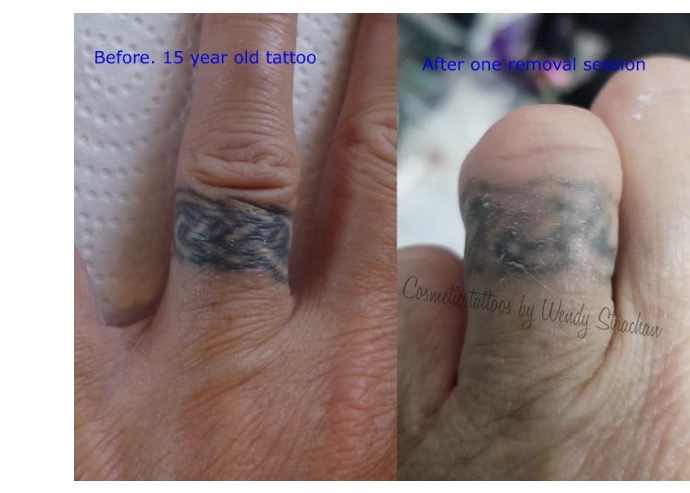 Tattoo Saline Removal