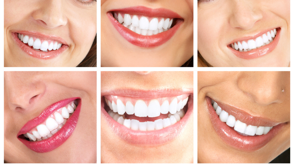 4 Week Whitening Touch Up