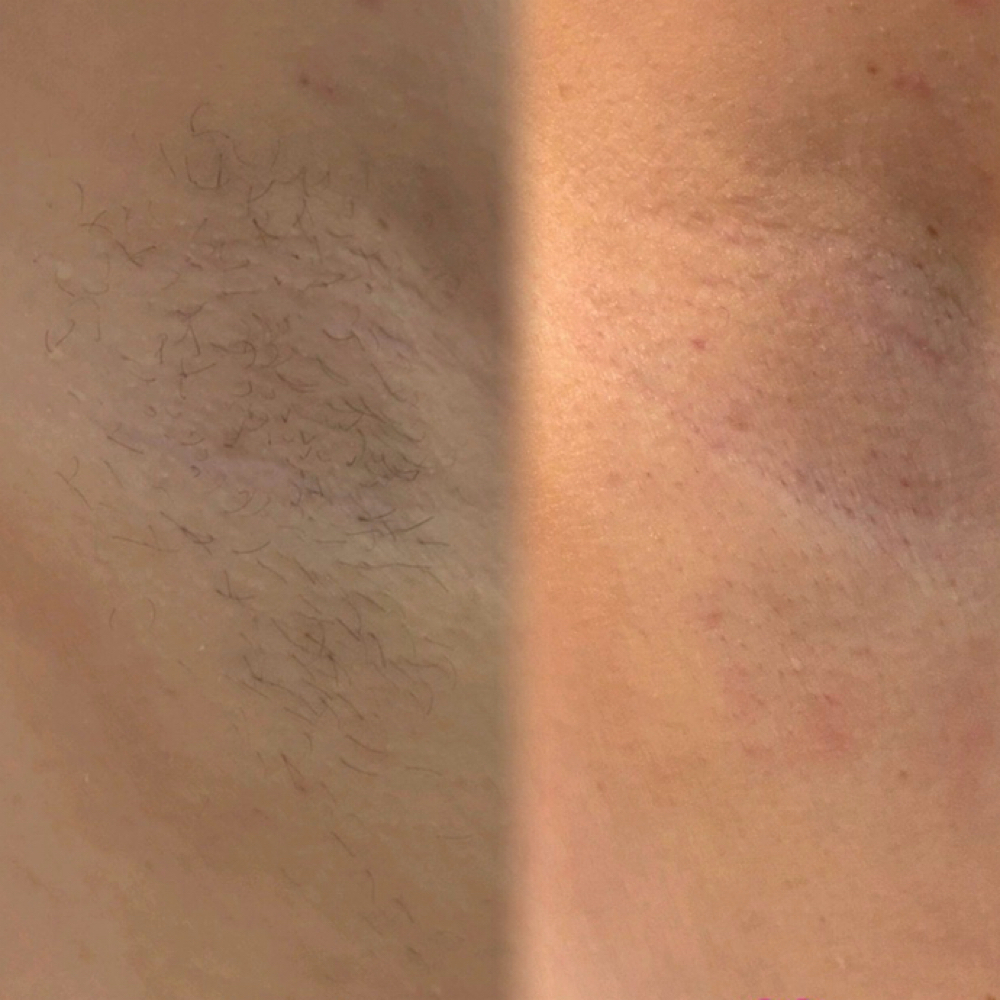 Underarm Wax at Lakeview Spa in Helendale, CA