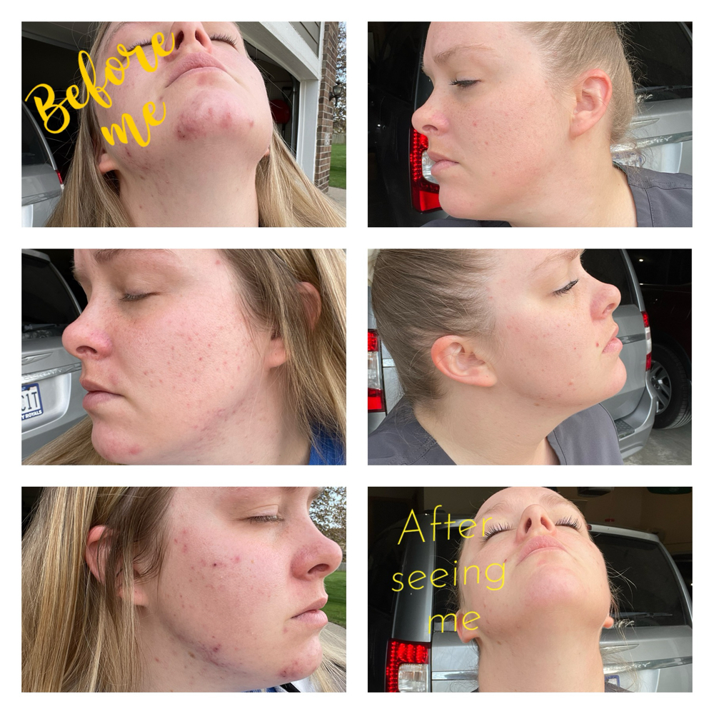 Acne Clarifying Facial