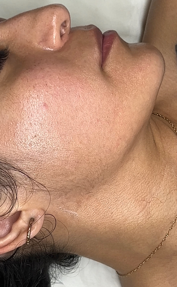 Add On Dermaplane