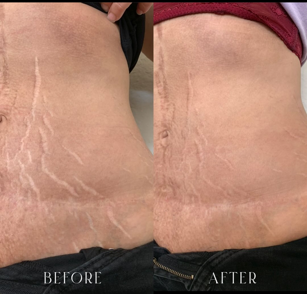 Scar Revision/ Stretch Mark Removal