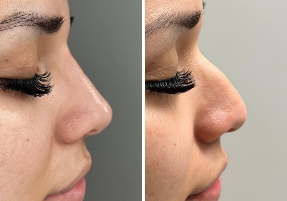 Non Surgical Rhinoplasty
