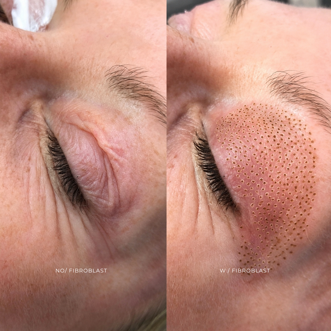 FIBROBLAST | PARPADOS SUPERIOR at EROXSPA in Houston, TX