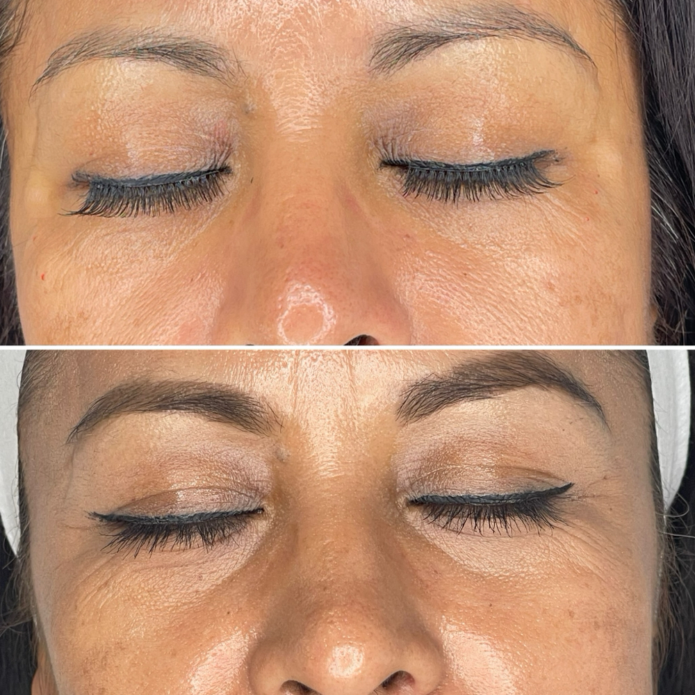FIBROBLAST PARPADO SUP E INF