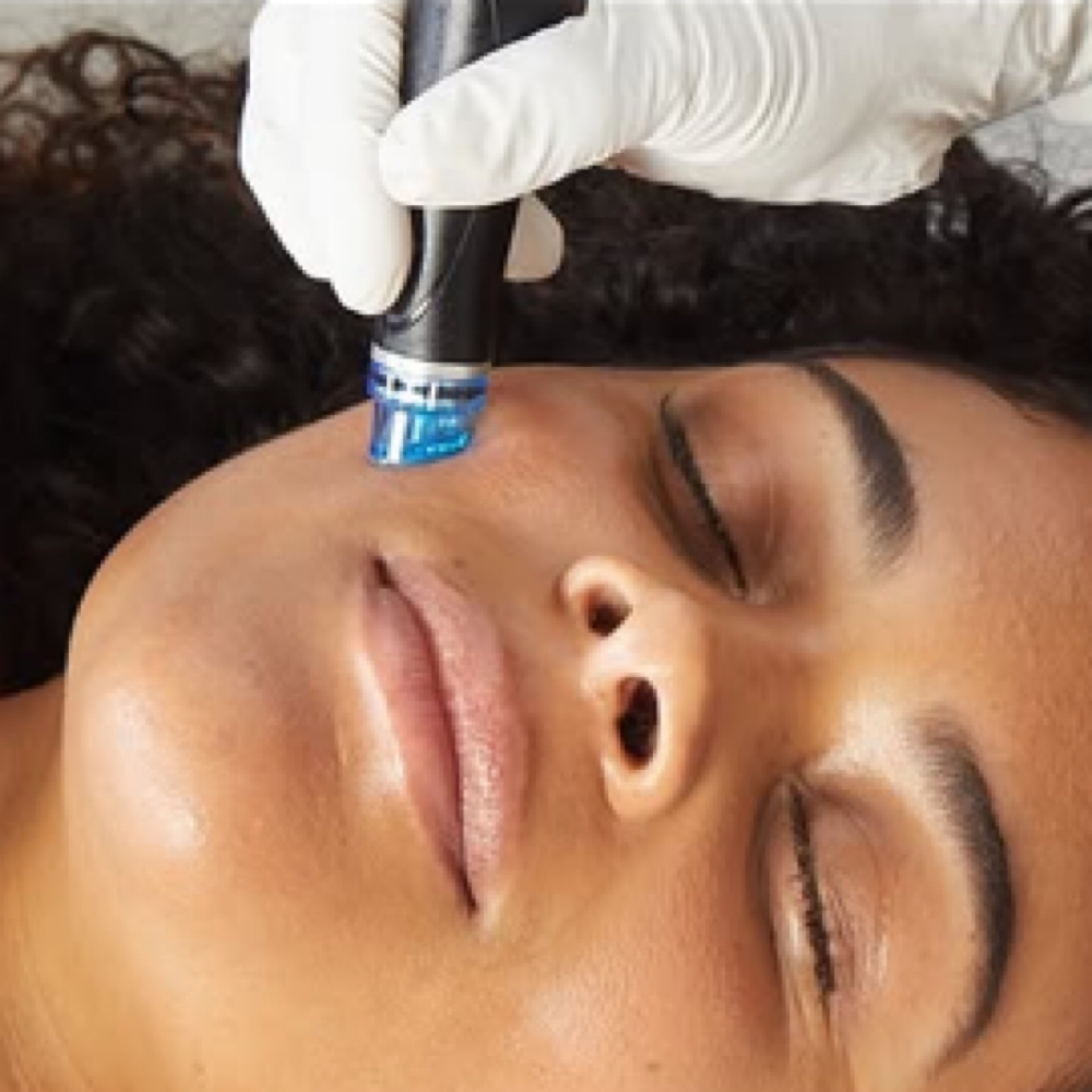 Hydrafacial Cleanse at Empowered Esthetic in Rancho Santa Margarita, CA